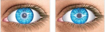 Gözde Astigmat Belirtileri ve Tedavisi