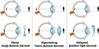 Astigmat Hipermetrop